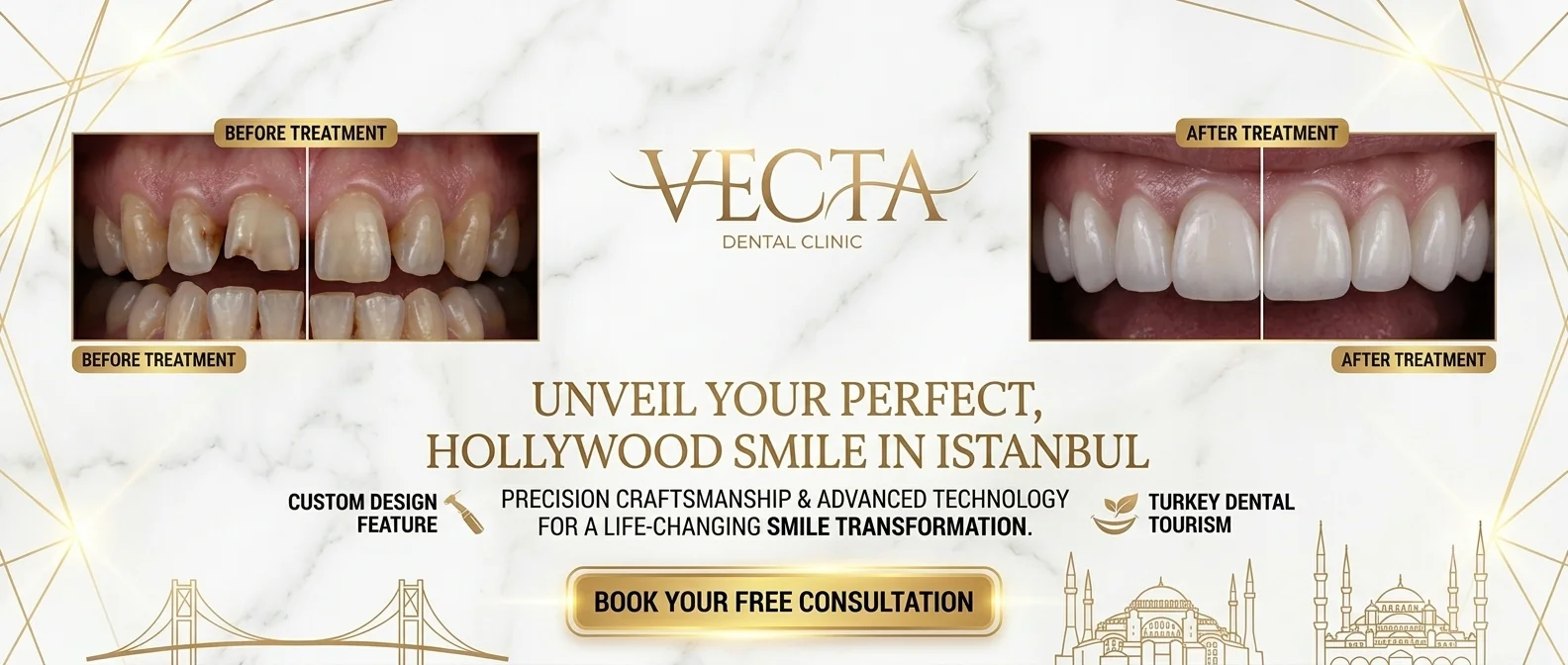 Premium Hollywood Smile treatment at Vecta Dental Clinic in Istanbul