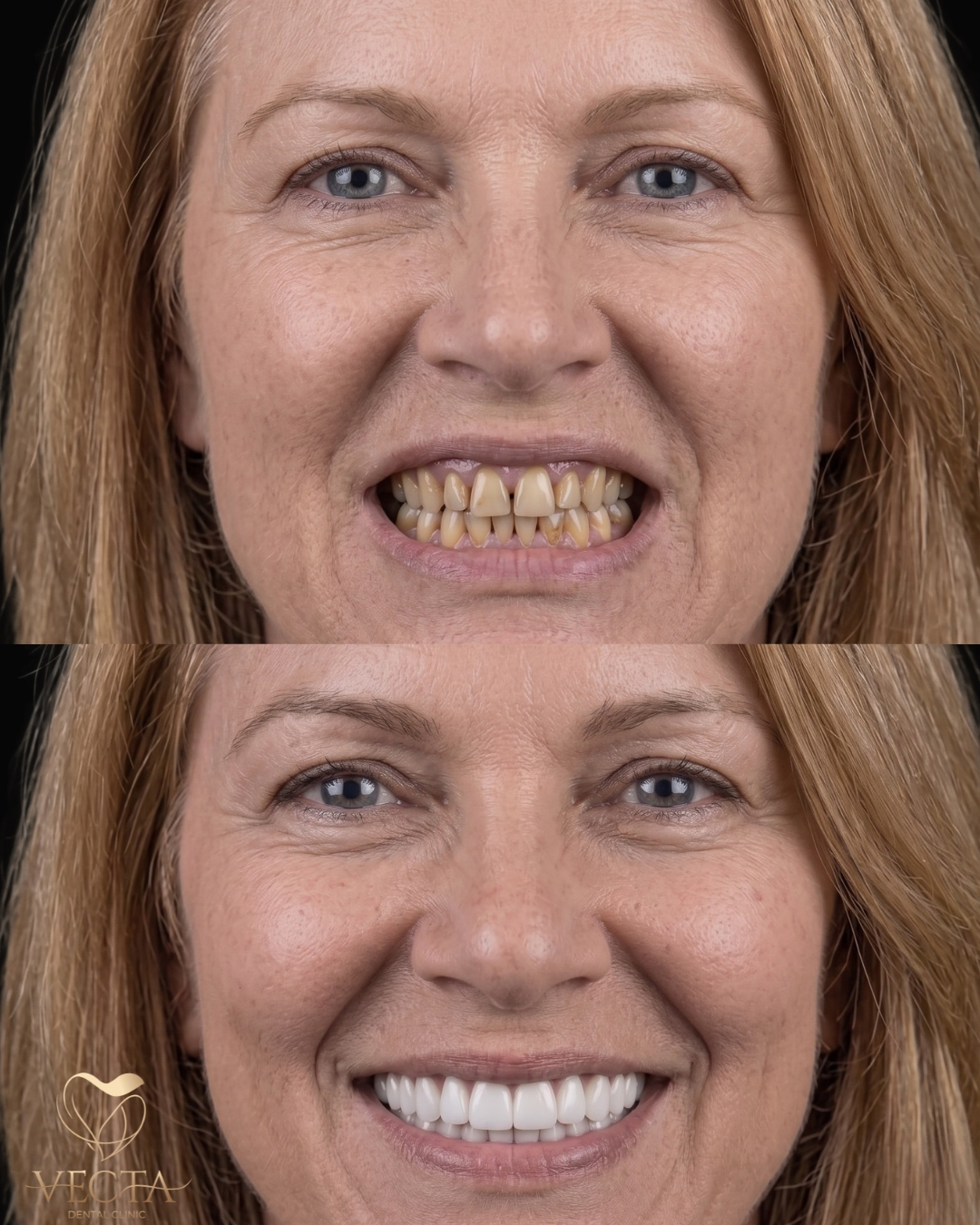 Best Hollywood Smile Istanbul