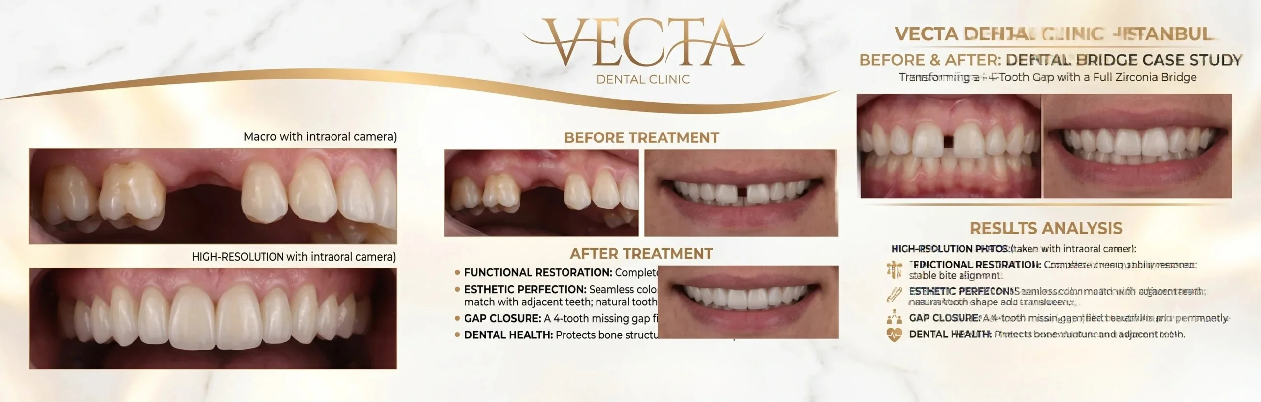 Dental bridges Istanbul Vecta Dental Clinic Before After