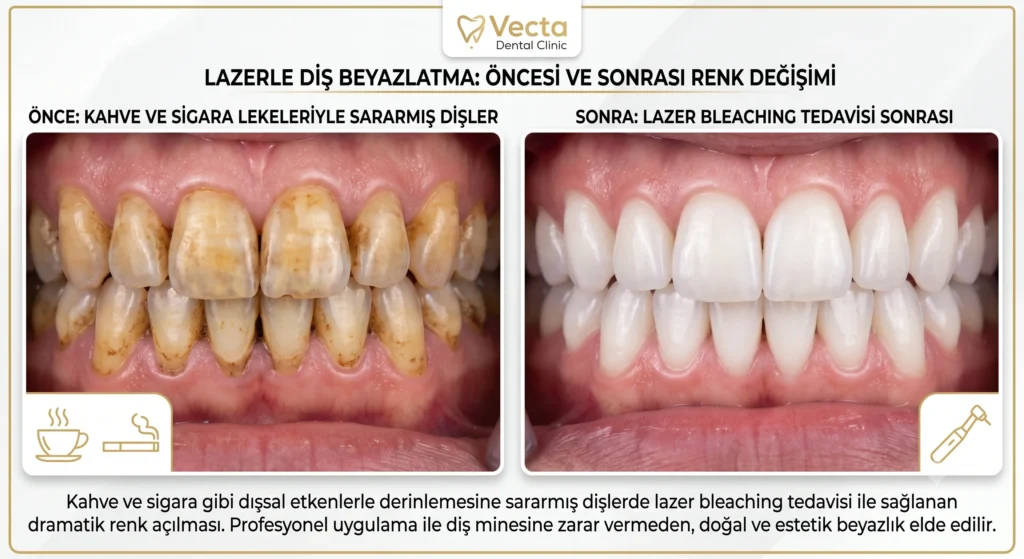 Diş Beyazlatma Bleaching İstanbul Vecta Dental Clinic Öncesi Sonrası