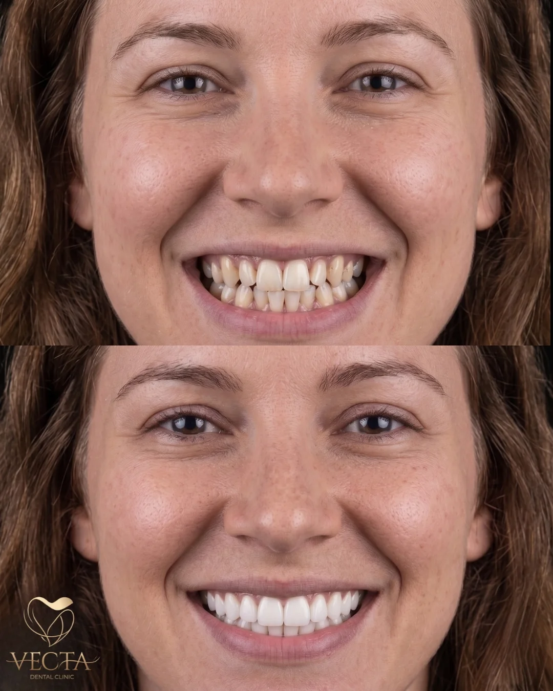 E-Max Porselen Veneers İstanbul | Vecta Dental Clinic