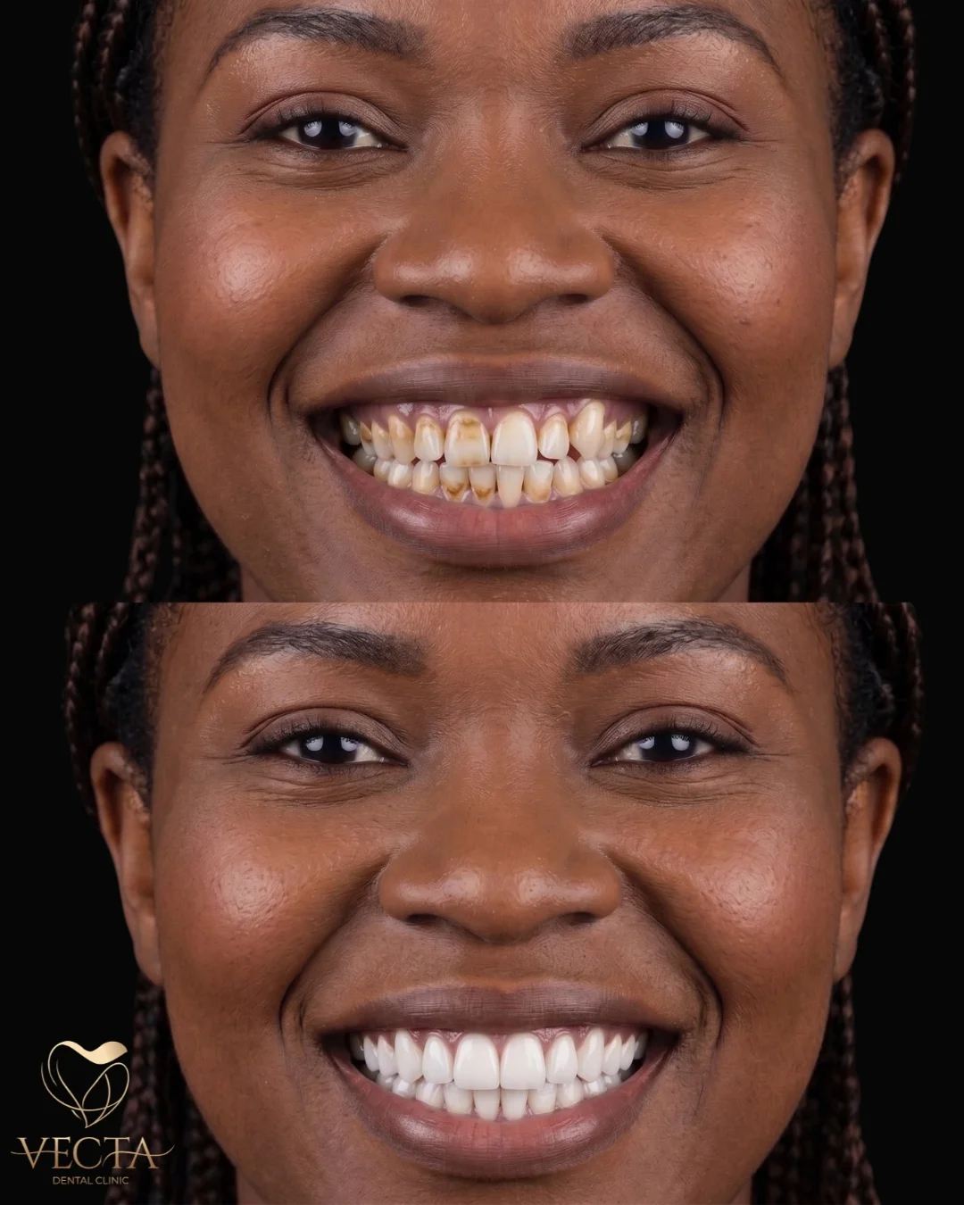Diş Kaplama (Crowns) İstanbul - Vecta Diş Kliniği