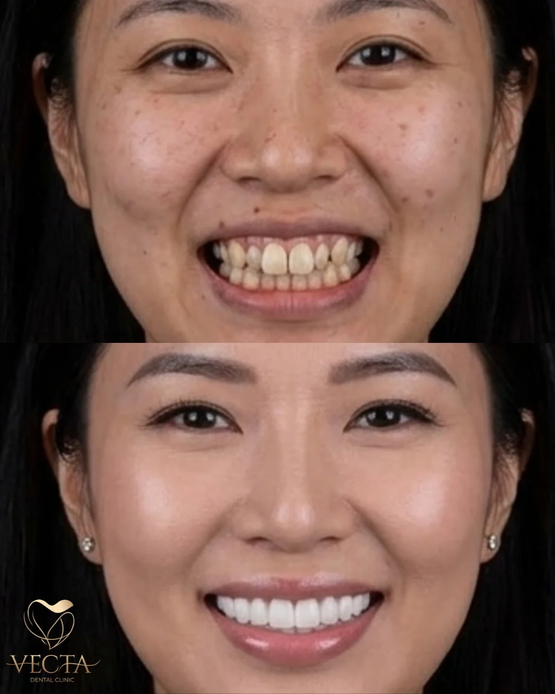 Hollywood Smile İstanbul - Estetik Diş Tasarımı | Vecta Dental