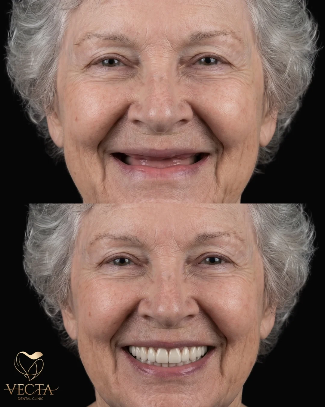 Hollywood Smile Öncesi ve Sonrası | İstanbul Vecta Diş Kliniği