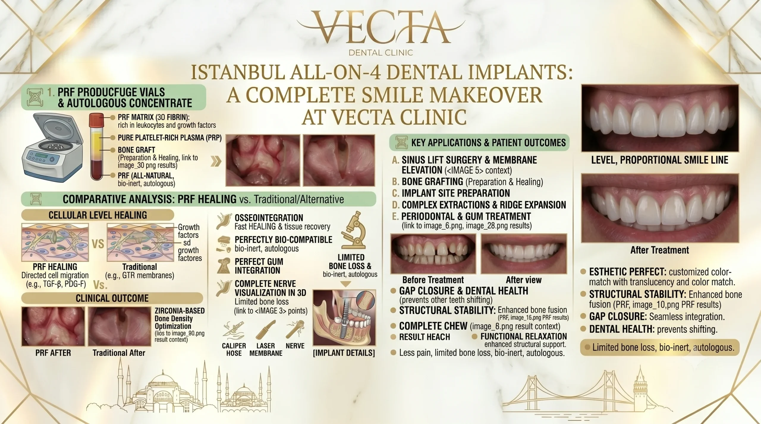 Premium All-on-4 dental implants treatment at Vecta Dental Clinic Istanbul