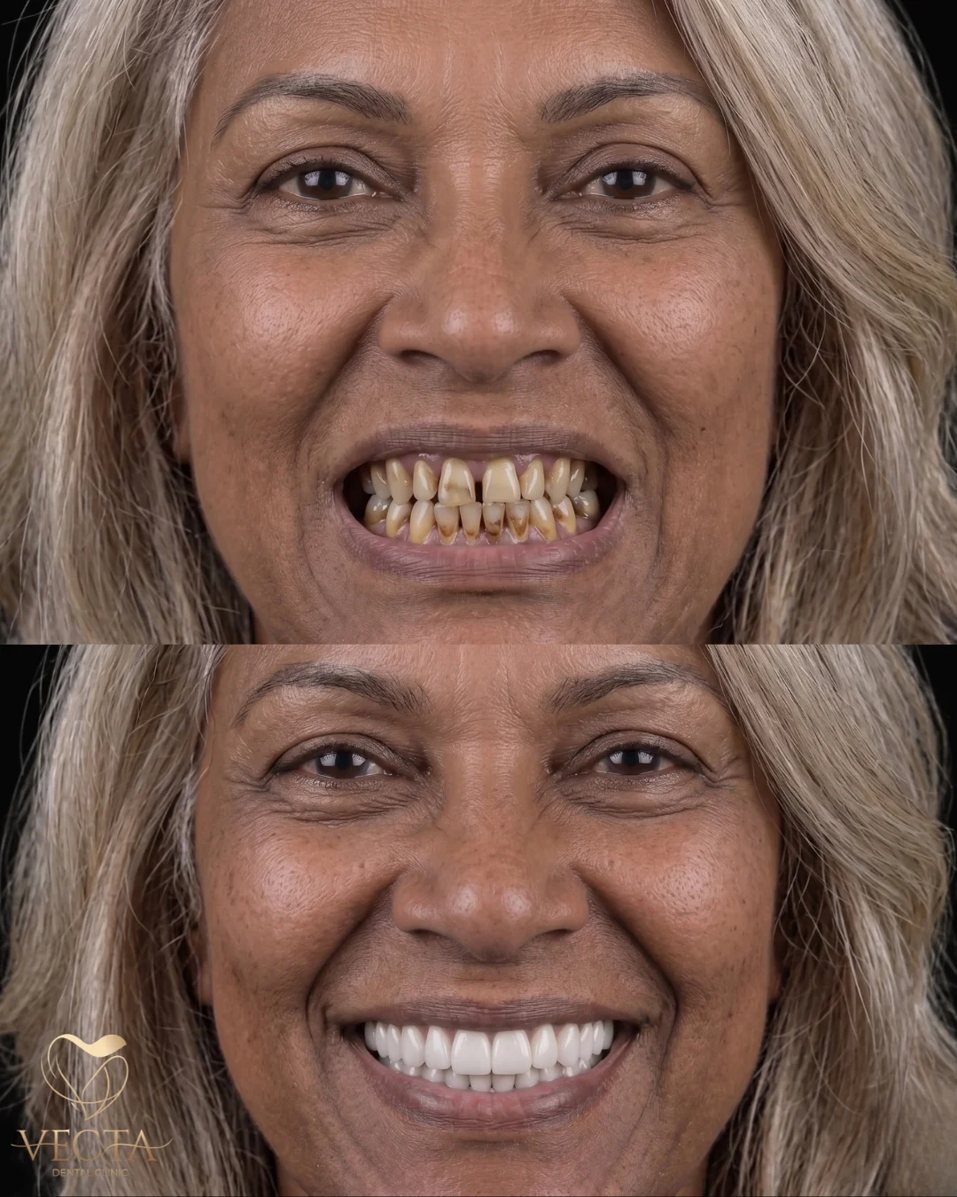 En İyi Diş Kliniği Sonuçları - Vecta Dental İstanbul