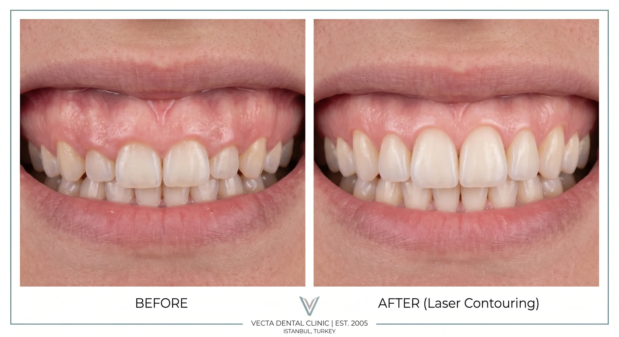Before and after laser gum contouring Turkey treatment