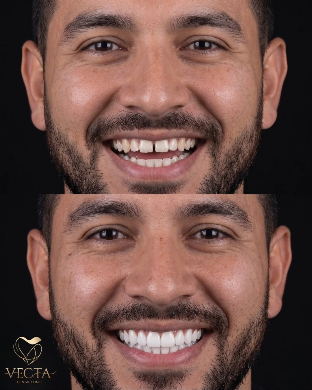 Lamine Diş Kaplama (Veneers) İstanbul - Vecta Dental