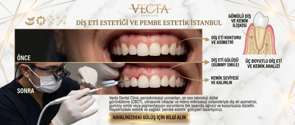 Diş Eti Estetiği Pembe Estetik İstanbul